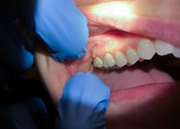 Best Emergency Dental Care for Abscessed Tooth in West Point, NY